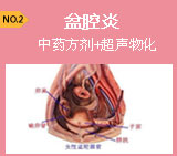 中药方剂+超声雾化净透--中西医结合治疗盆腔炎