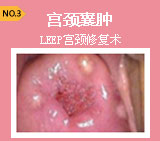 美国LEEP宫颈修复术 只除糜烂不伤宫颈
